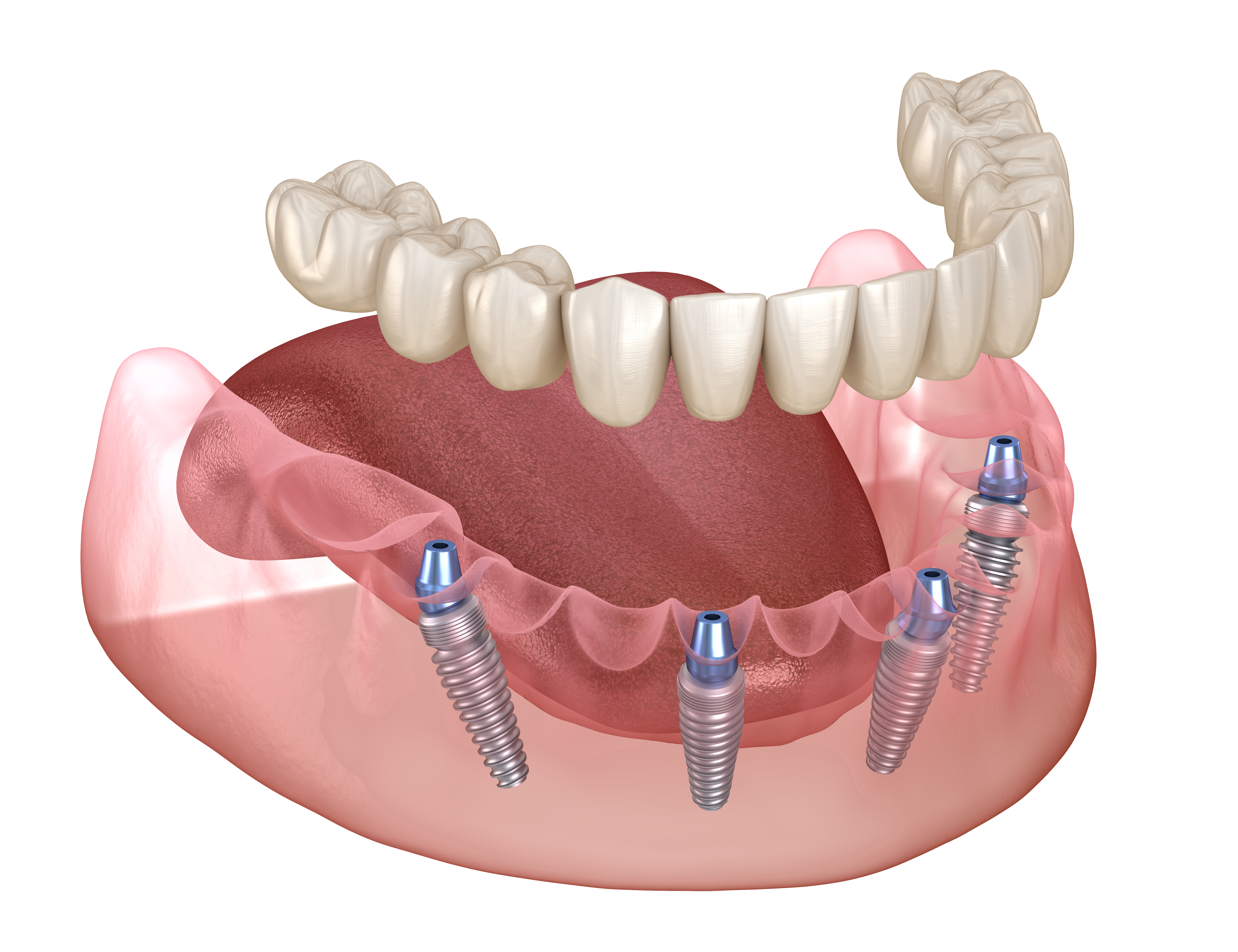 The Dangers of Avoiding Dental Implants for Rotting Teeth